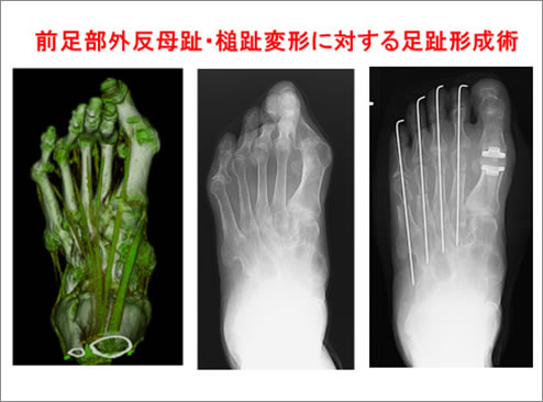 前足部外反母趾･槌趾変形に対する足趾形成術